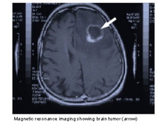 Sample research paper on brain cancer